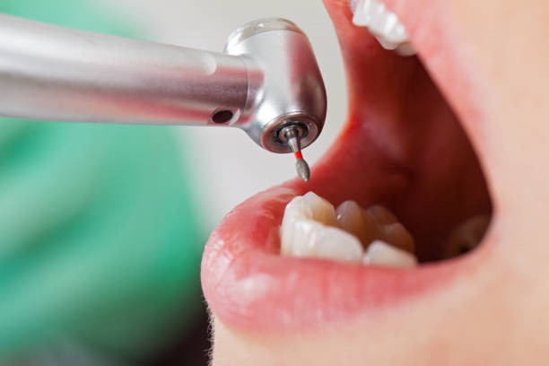 Best Emergency Root Canal Treatment in Tanaina, AK